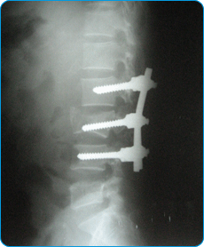 Post-operative x-ray of Donald Manurong